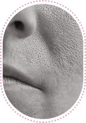 Pores dilatés visibles